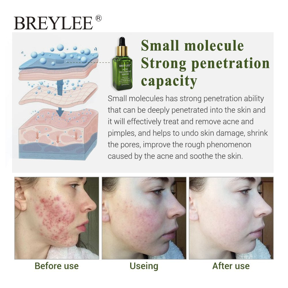 BREYLEE Acne Treatment Serum Face Facial Anti Acne Scar Removal