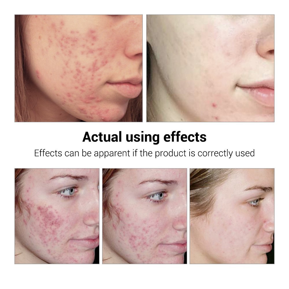 BREYLEE Acne Treatment Serum Face Facial Anti Acne Scar Removal