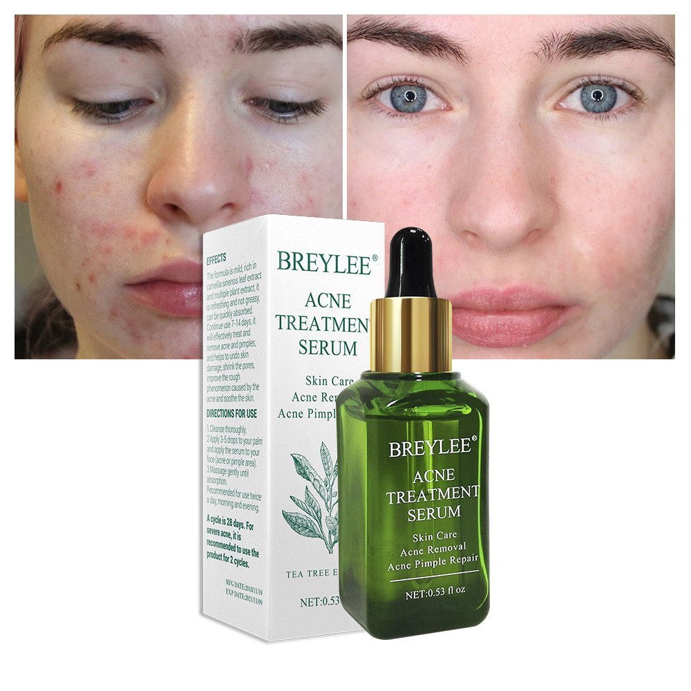 BREYLEE Acne Treatment Serum Face Facial Anti Acne Scar Removal