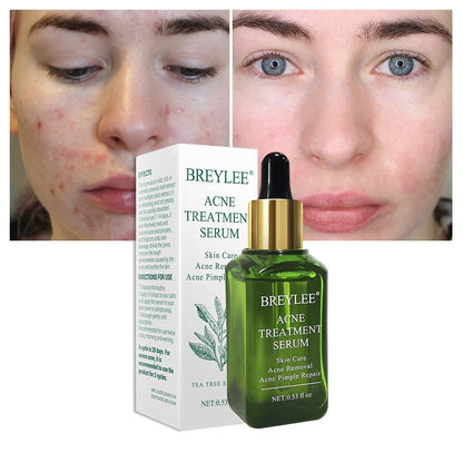 BREYLEE Acne Treatment Serum Face Facial Anti Acne Scar Removal